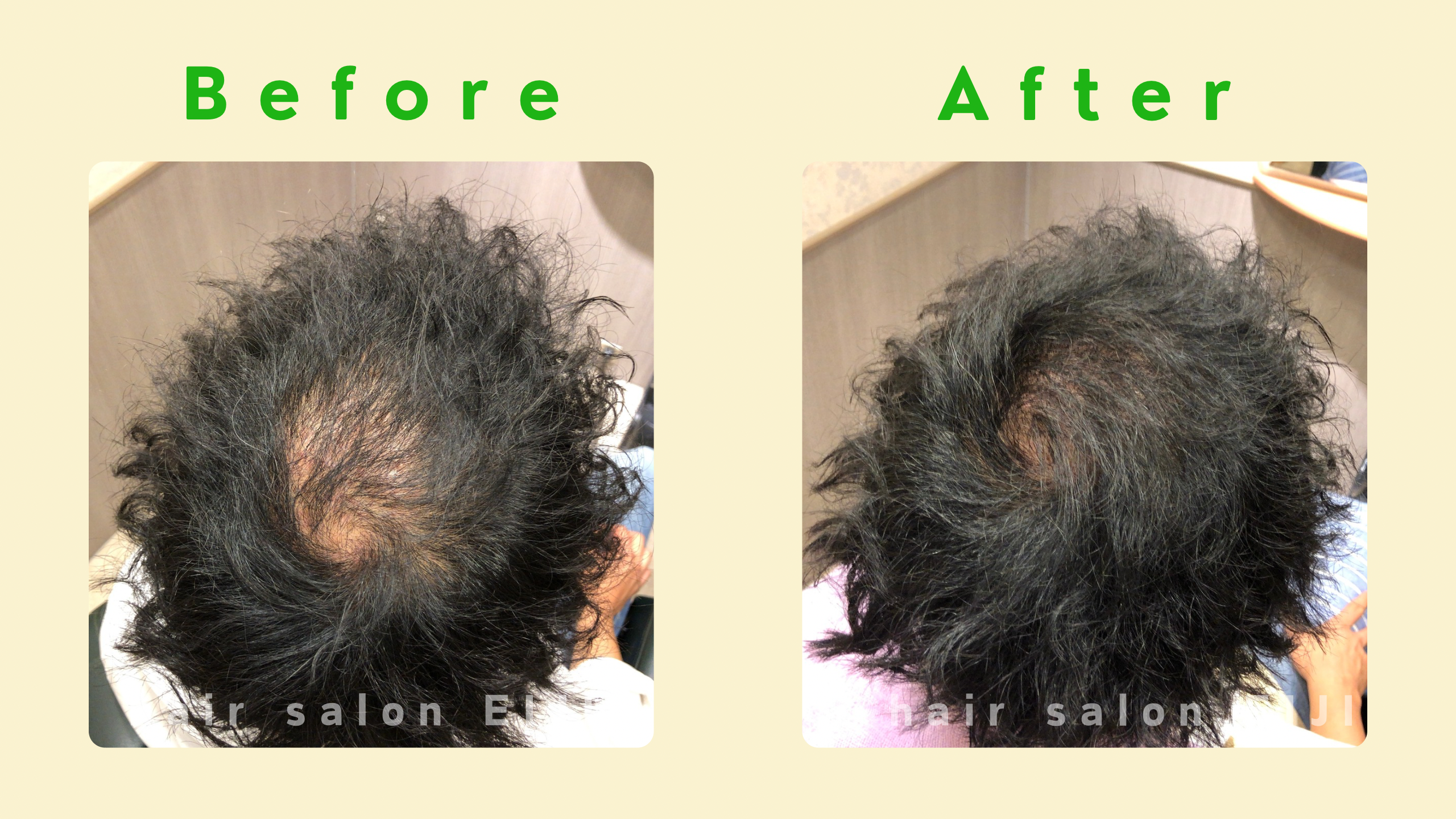 東京のヘアサロンで施術した、男性のつむじ部分への増毛エクステのビフォーアフター写真