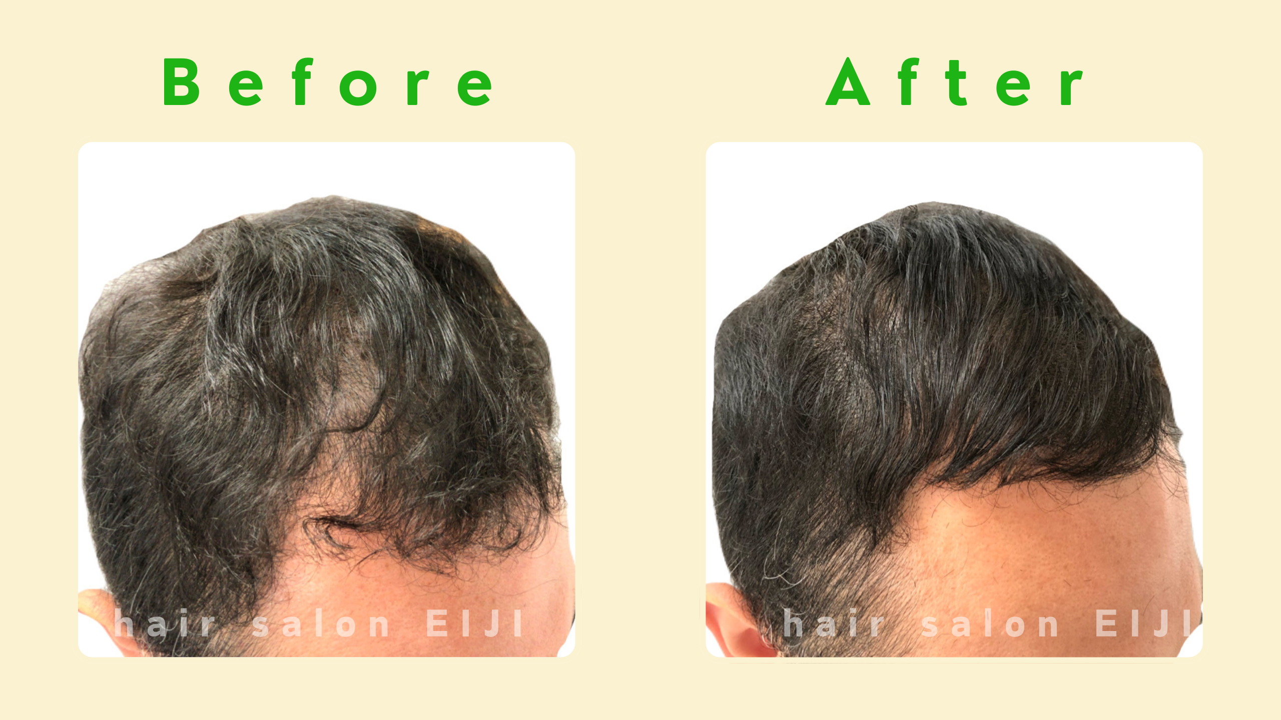 前髪が薄くなった男性への増毛エクステ施術のBefore After(関東・hair salon EIJI)
